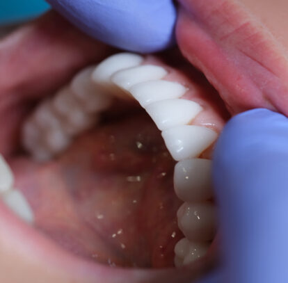 How to Choose the Right Composite Veneer for You?