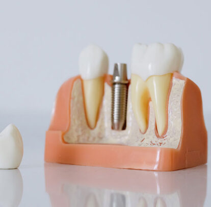 Exploring Dental Implants in Hamilton: Your Path to a Confident Smile