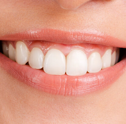 Teeth Whitening in Hamilton for Different Types of Teeth Stains