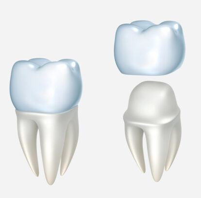 The Significance of Proper Care for Your Teeth Crowns