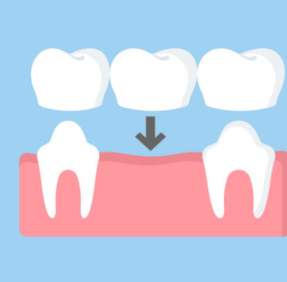 Common Misconceptions about Dental Bridges Debunked
