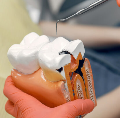The Importance of Treating a Root Canal Infection by a Dentist in Hamilton