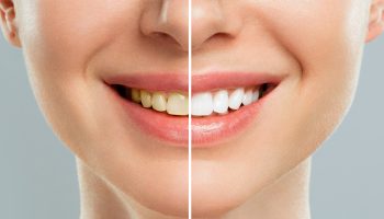 How to Maintain a Gleaming White Smile Long After Teeth Whitening?