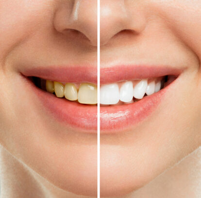 How to Maintain a Gleaming White Smile Long After Teeth Whitening?